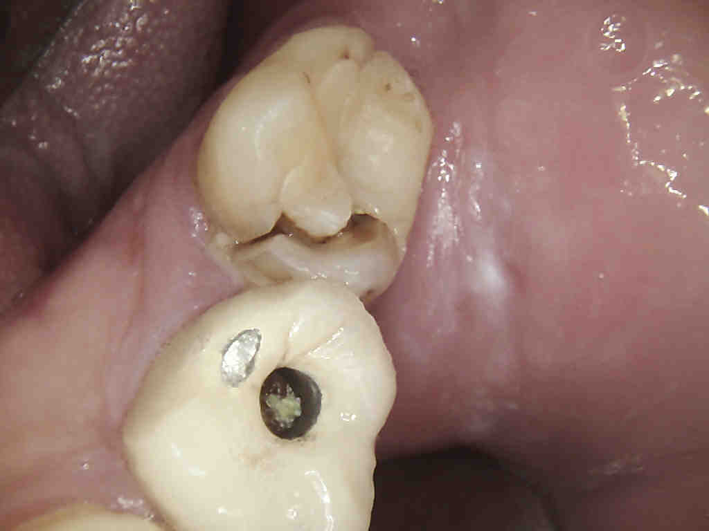 FRATTURA DEL DENTE - CHE ROTTURA! - Dental Experience